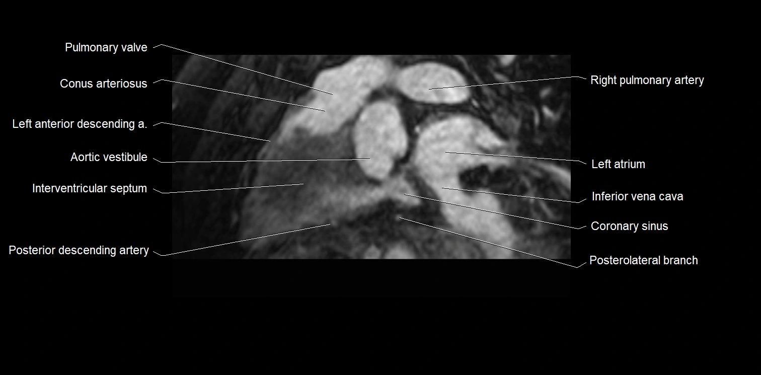 MRI heart and coronary arteries two chamber(sagittal)  anatomy image 19.webp